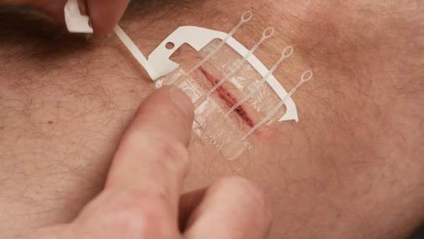 ZipStitch, una nueva tirita capaz de suturar heridas sin aguja